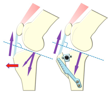 TTA 脛骨粗面前方転移術